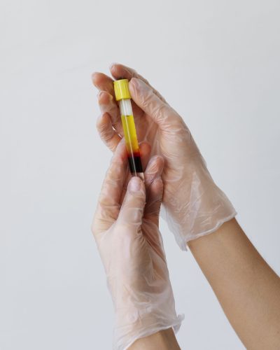 manos-sosteniendo-vial-para-tratamientos-prp